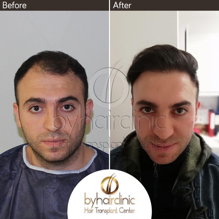 Haartransplantation Türkei Vorher und Nachher