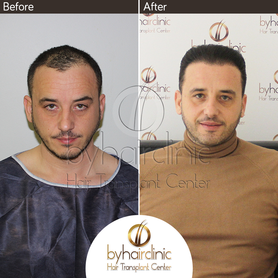 Hair Transplant Results – byhairclinic hair transplant center in istanbul  Turkey