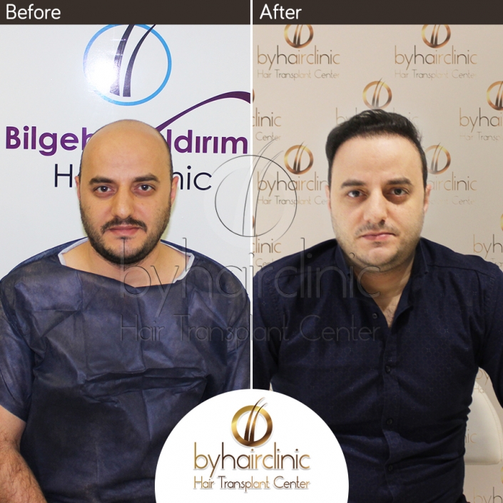 Haartransplantation Türkei Vorher und Nachher