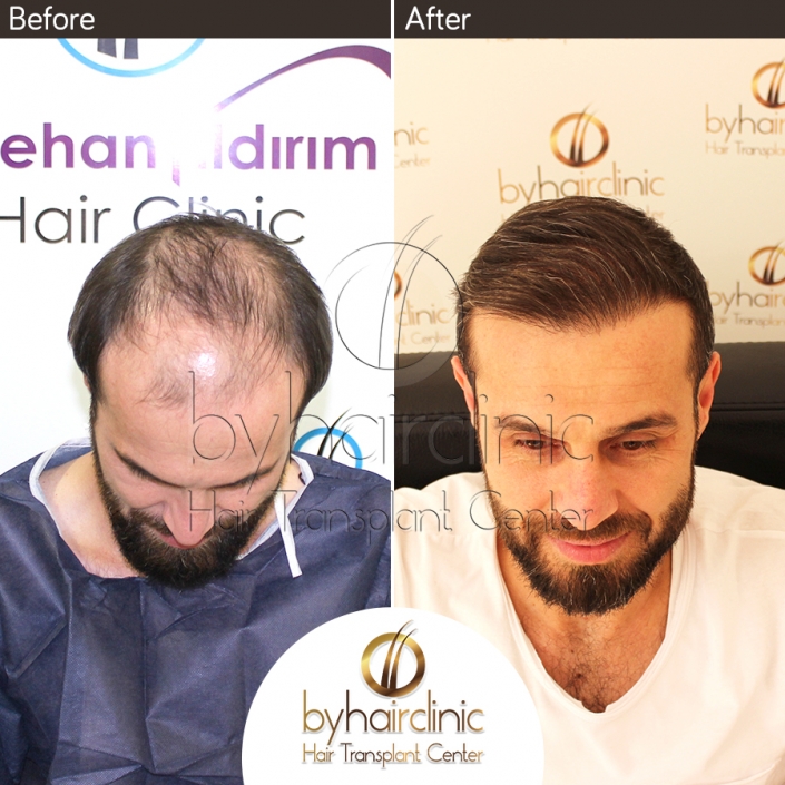 Greffe De Cheveux Turquie Avant et Après