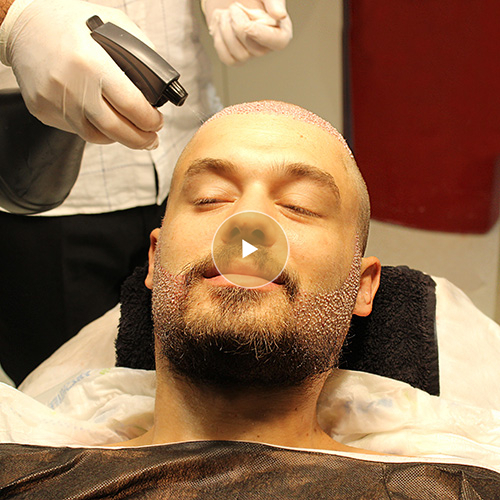 Opération de Greffe de Cheveux, Steven Locatelli