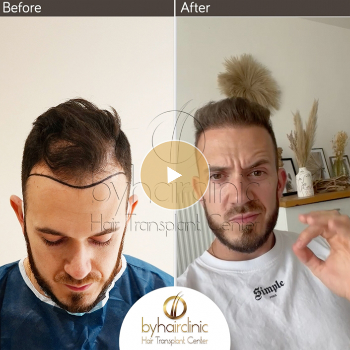 Video resultat de la greffe de cheveux