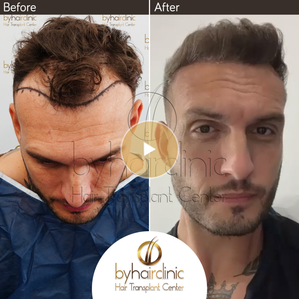 Greffe de cheveux turquie avant et après – byhairclinic hair transplant