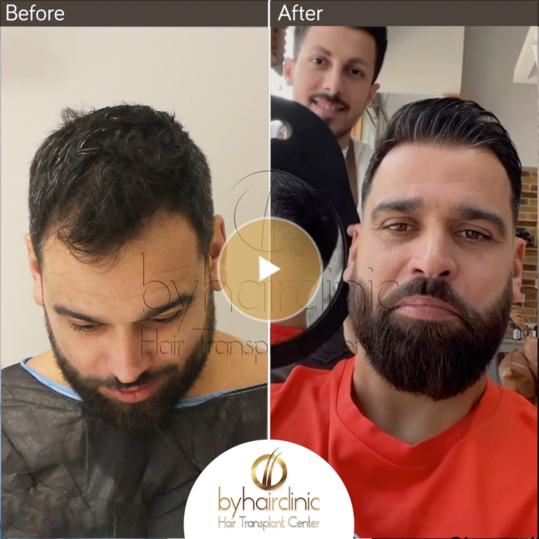 Video résultat de la greffe capillaire de Nore Abdelali Greffe De Cheveux Turquie Avant et Après