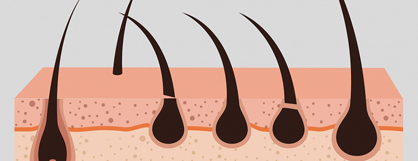 The Meaning of Hair Transplants What is a Transplant?