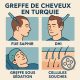Greffe de Cheveux en Turquie