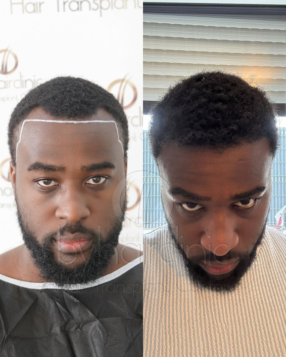 Résultat greffe de cheveux avant et après 6 mois