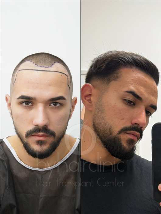 Résultat greffe de cheveux avant et après 6 mois