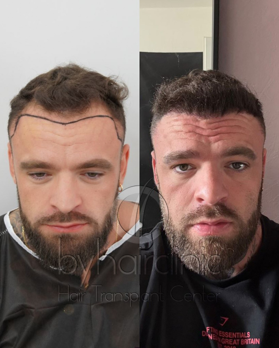 Résultat greffe de cheveux avant et après 6 mois