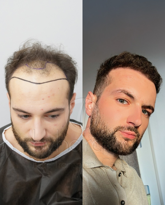 Résultat greffe de cheveux avant et après 6 mois