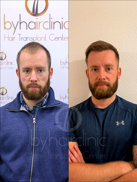 Résultat greffe de cheveux avant et après 8 mois