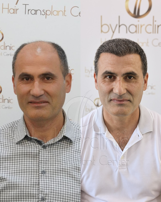 Résultat greffe de cheveux avant et après 8 mois