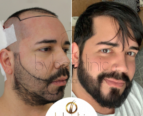 Resultado del trasplante capilar y de barba en Turquía