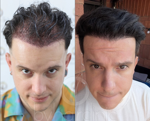 Resultado del trasplante capilar en Turquía (DHI)