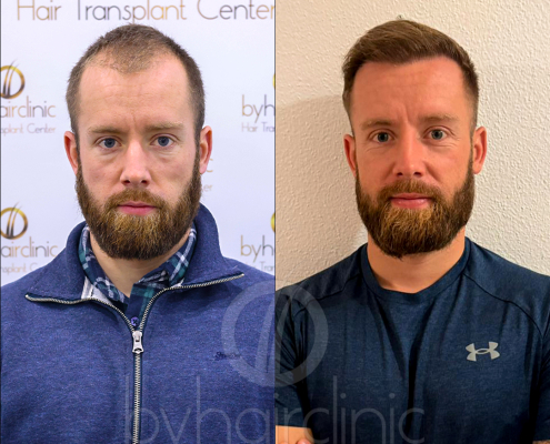 Resultado del trasplante capilar en Turquía