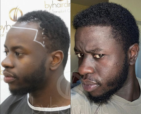 Resultado del trasplante capilar en Turquía