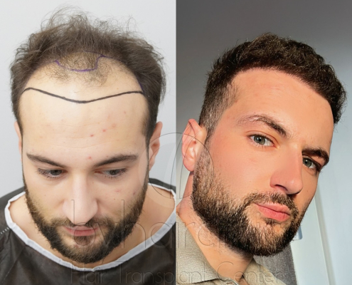 Resultado del trasplante capilar en Turquía