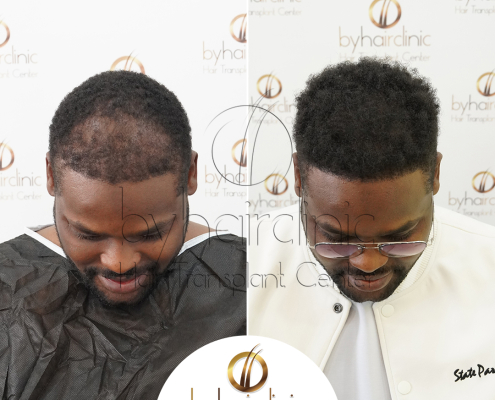 Resultado del trasplante capilar en Turquía