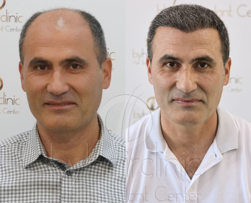 Trasplante Capilar Turquía Nuestra Clínica