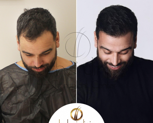 Resultado del Trasplante Capilar en Turquía