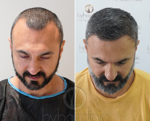 Resultado del trasplante capilar en Turquía