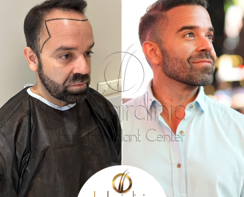 Resultado del trasplante capilar en Turquía