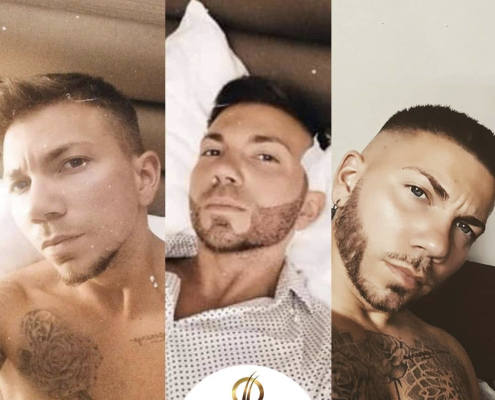 Resultado del trasplante de barba en Turquía