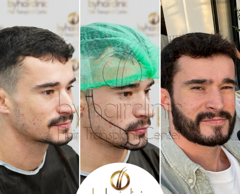Resultado del trasplante de barba en Turquía