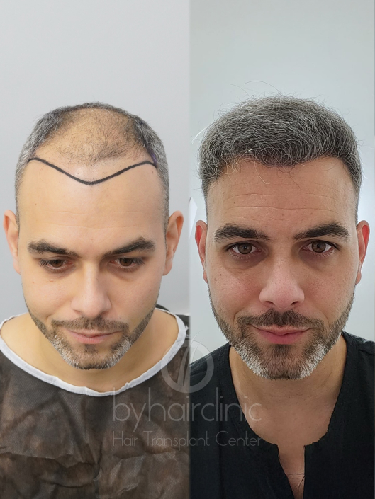 Résultat Greffe de Cheveux