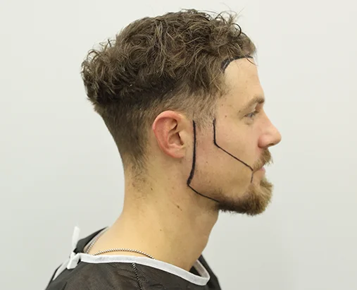 Greffe De Barbe Et De Moustache Turquie 2 Zone donneuse utilisée pour une greffe de barbe et de moustache