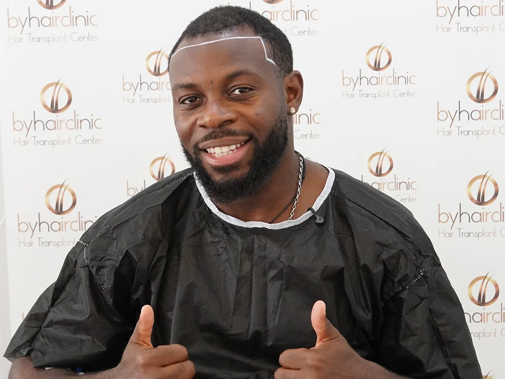 Greffe de Cheveux de Noé D’Almeida en Turquie 4 Consultation avant la greffe de cheveux de Noé D’Almeida chez byhairclinic