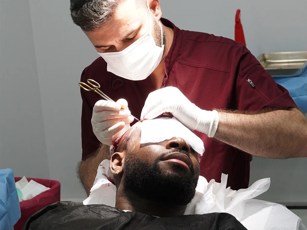 Greffe de Cheveux de Noé D’Almeida en Turquie 7 Ouverture des canaux lors de la greffe de cheveux de Noé chez byhairclinic